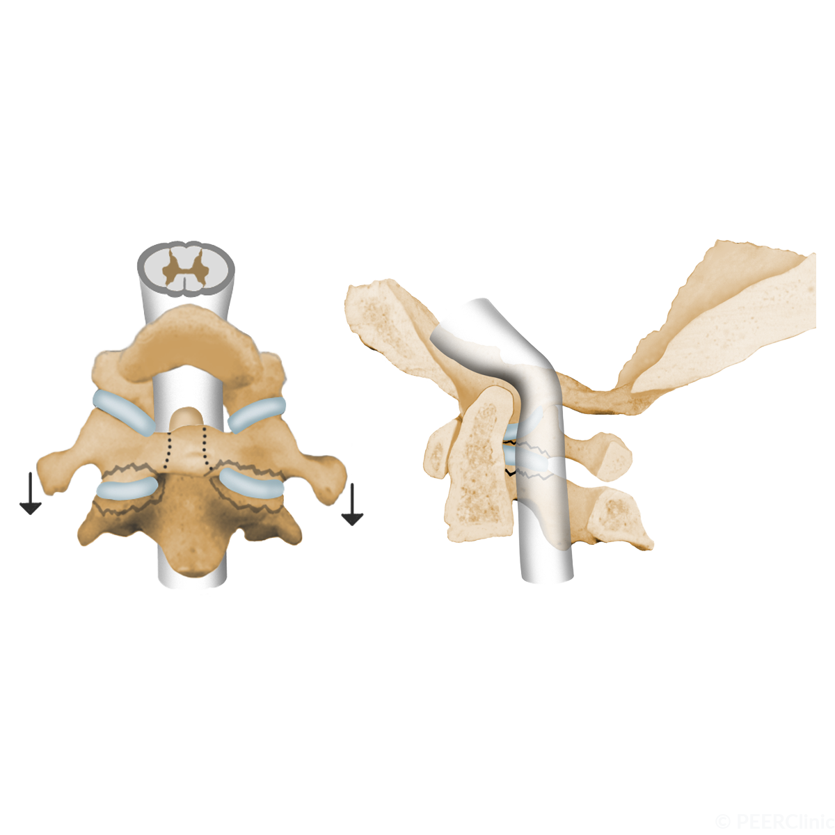 Basilar invagination refers to cephalad migration of the c-spine in relation to the foramen magnum